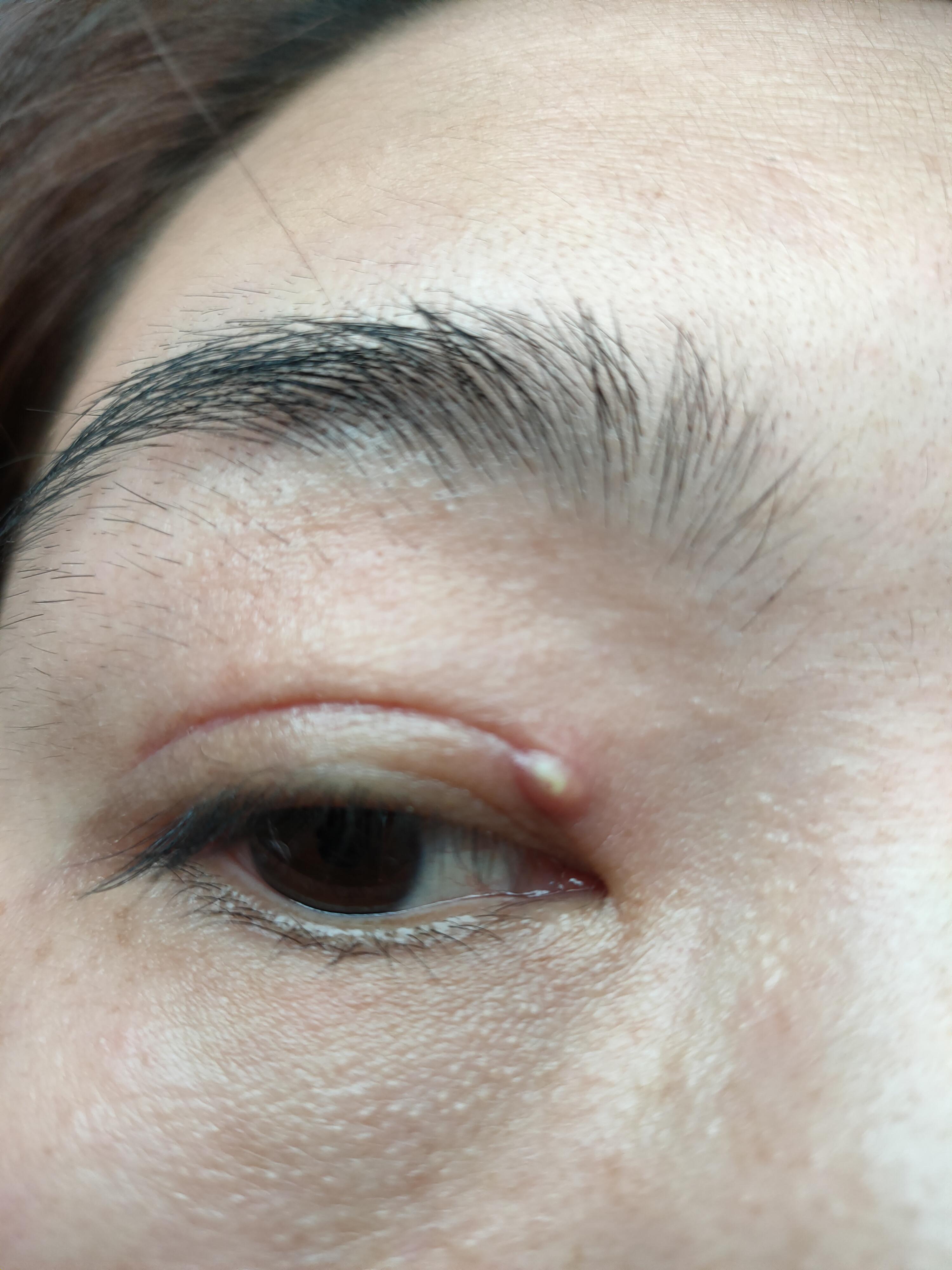 双眼皮增生了怎么办 #医美科普挑战赛#  有些人做完双眼皮会增生,这是