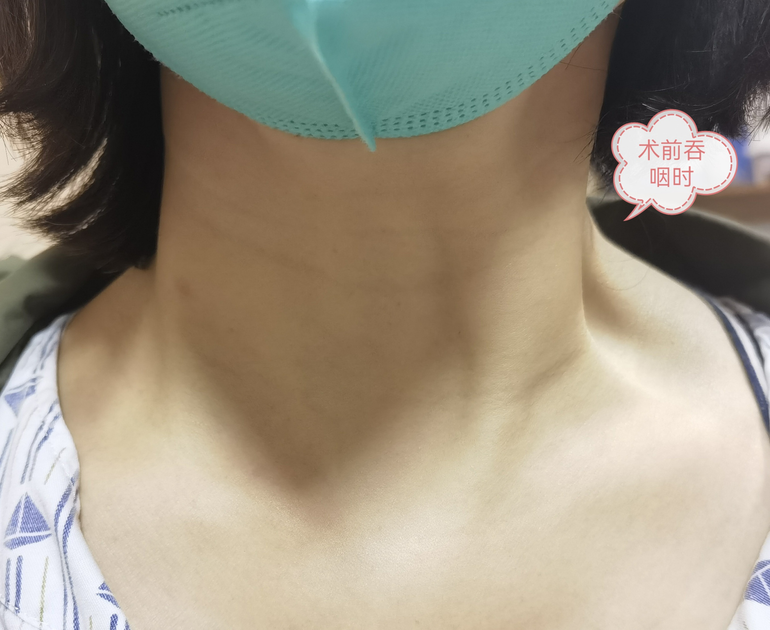 肩胛舌骨肌综合征矫正术与甲状腺癌根治术一起完成  王培松副主任医师