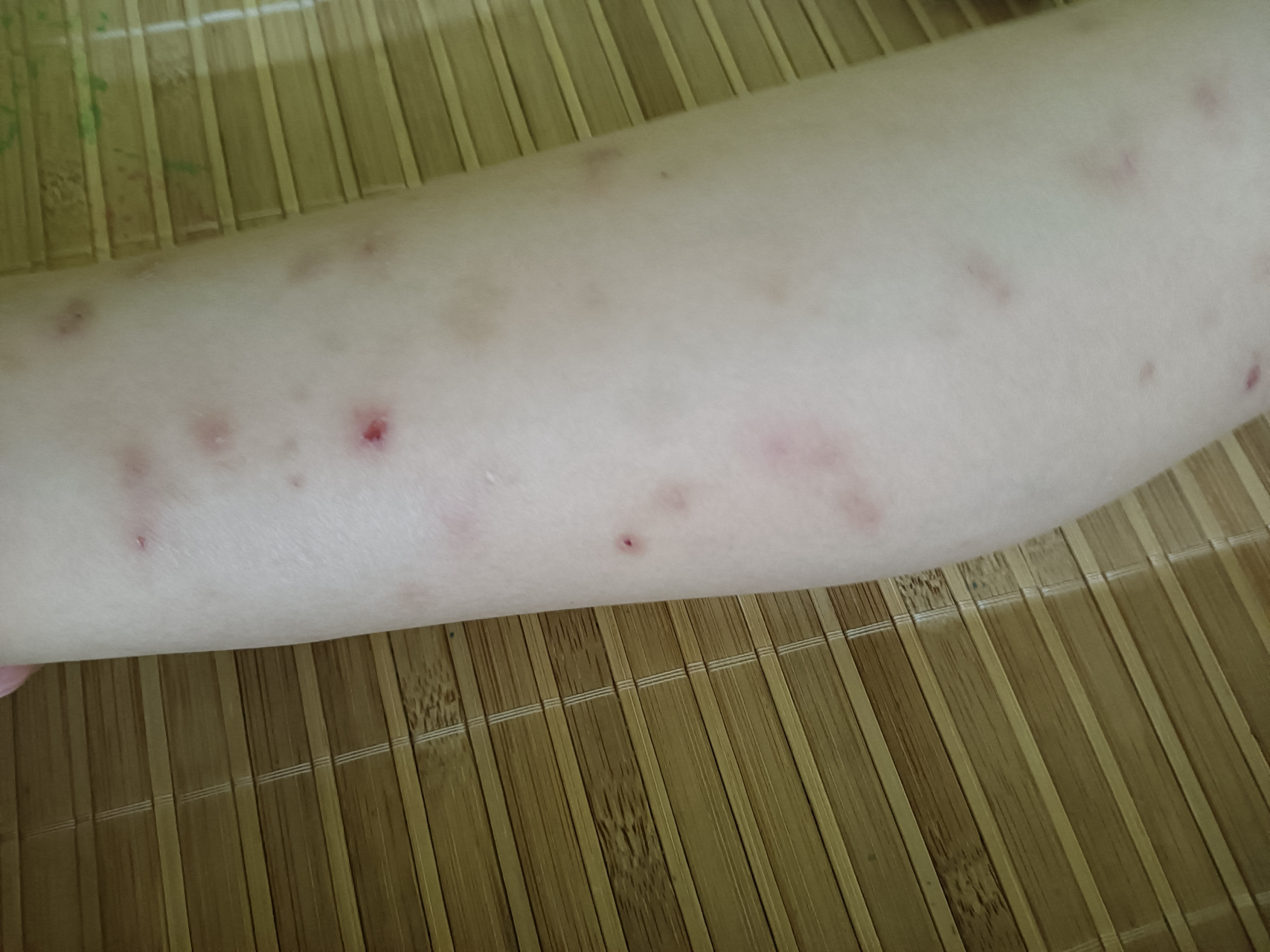 孩子的腿被蚊子咬的不成样子了,今年的蚊子怎么这么厉害呢?