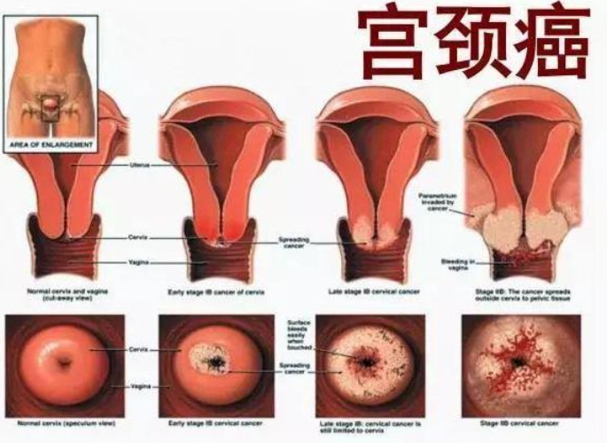 宫颈癌变不会悄无声息,下半身若有这2个表现,需要引起重视