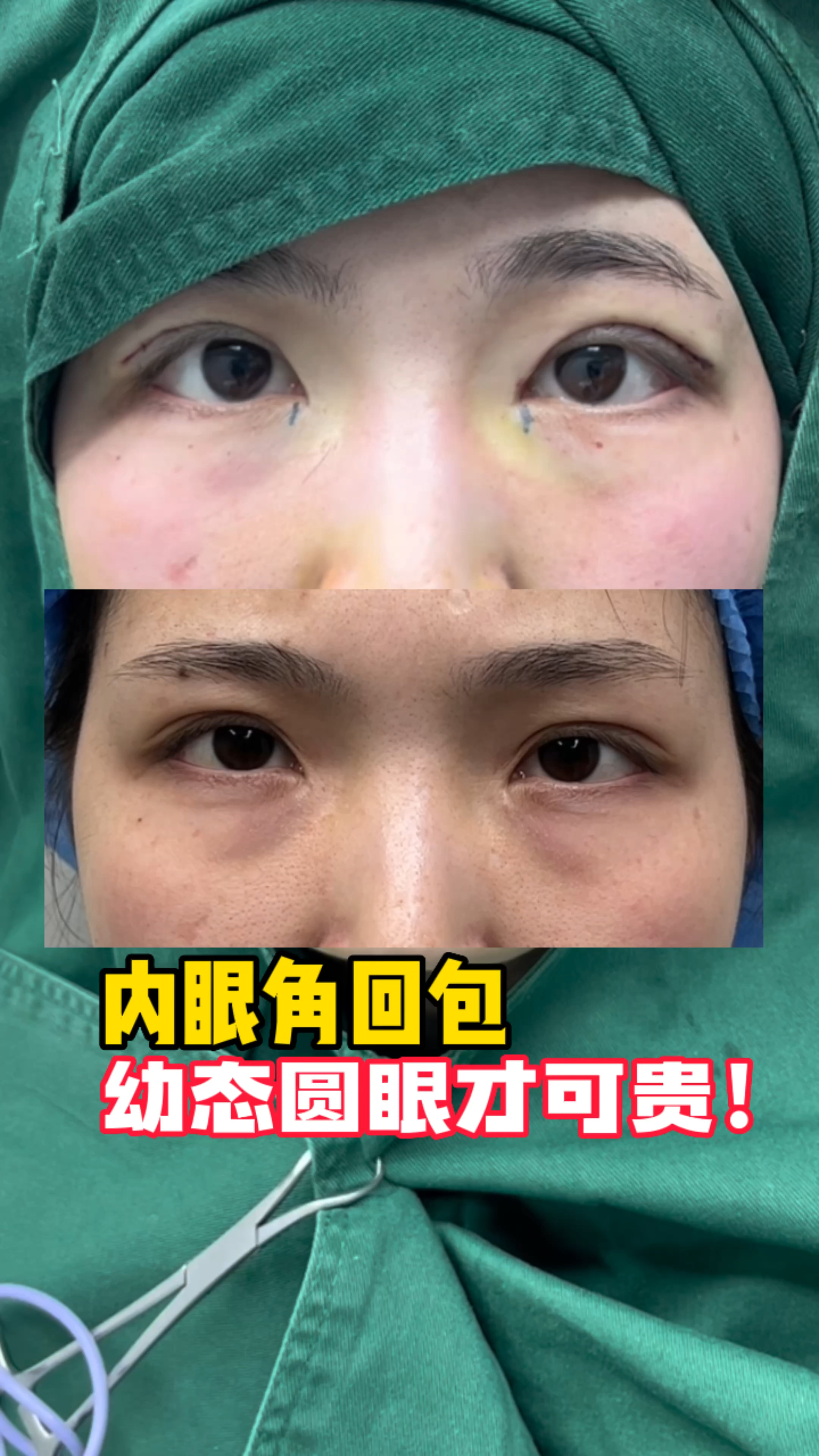 安徽姑娘,内眼角回包术后,直呼:好看好看,幼态了!