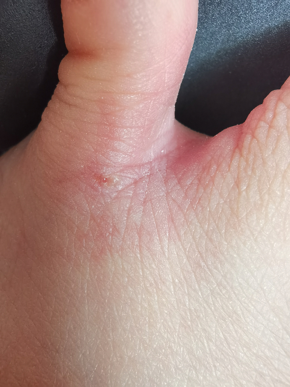 脚丫子被蚂蚁咬了,一个月了还没好,痒到怀疑人生,有什么好办法吗?