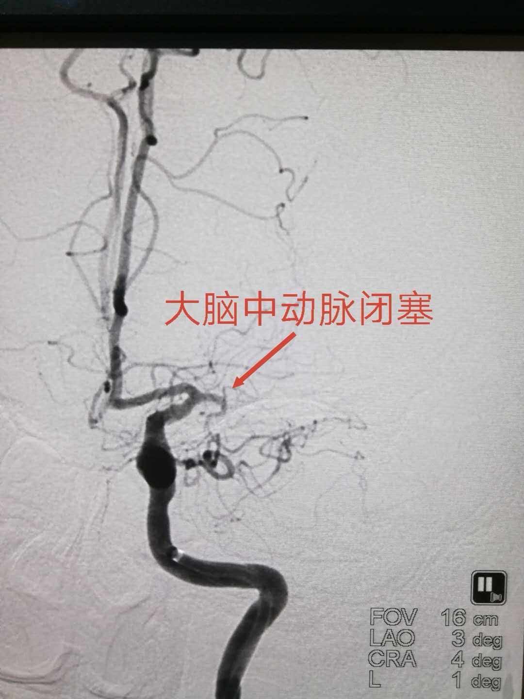 大脑中动脉闭塞会自愈吗