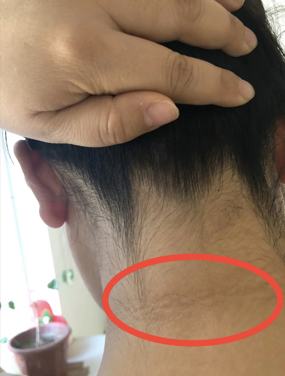 很多胖友,  眼圈黑,脖子黑,其实那不是脏,  而是胰岛素抵抗导致的