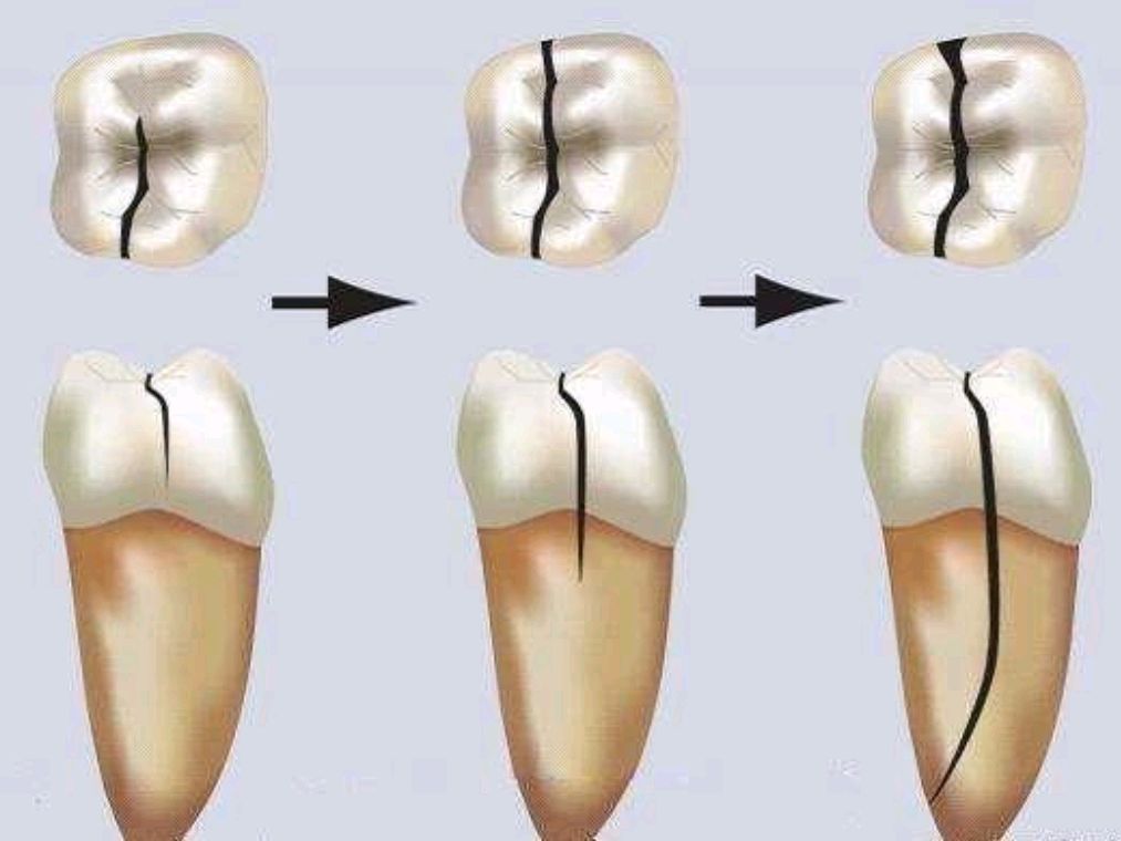 牙齿上为什么会有裂纹,可以修复吗?