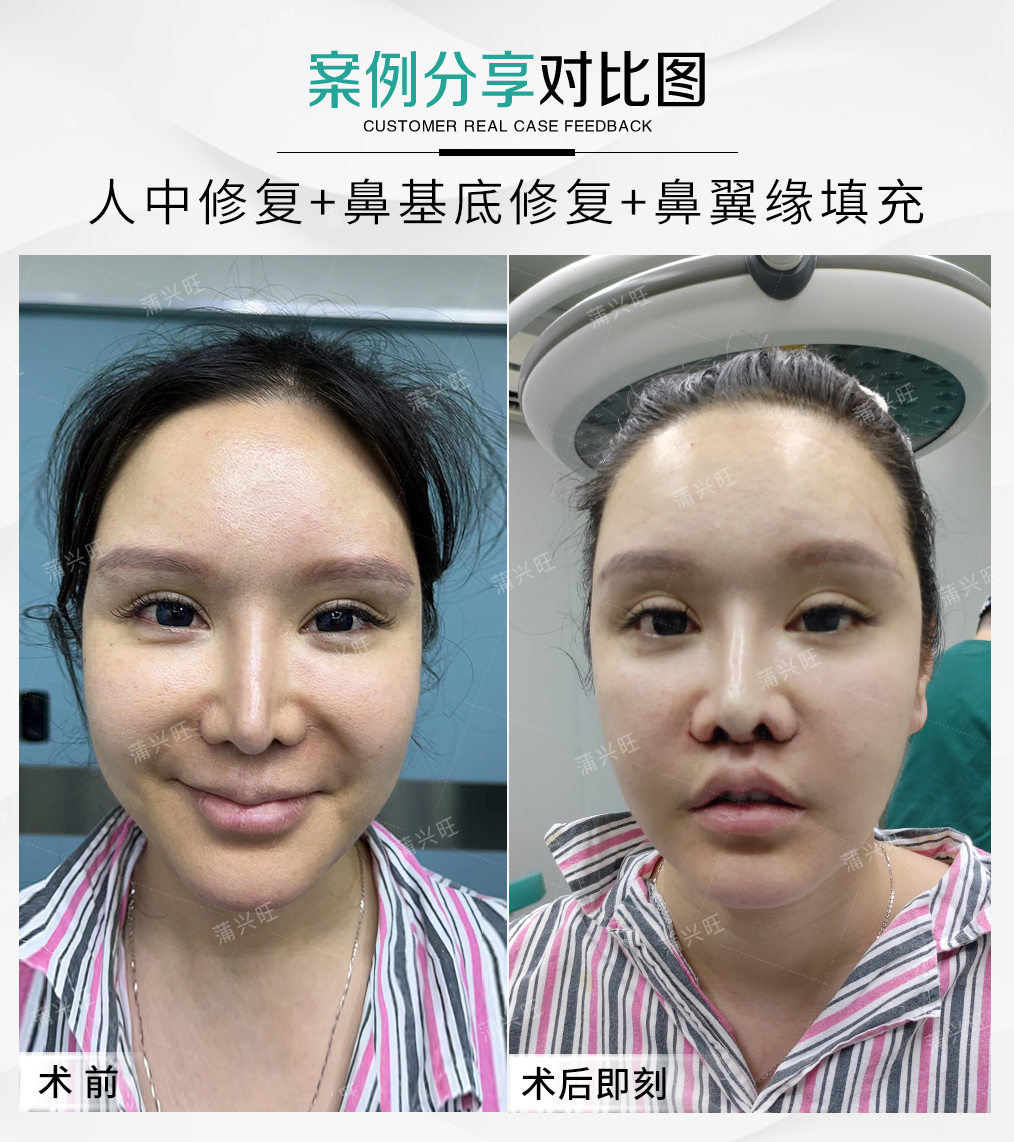 鼻基底修复,将原来的硅胶置换为膨体,鼻翼基底鼻小柱基底整体抬高