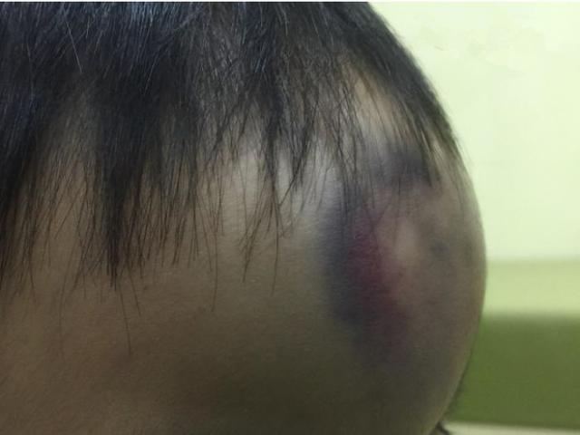 小孩撞到头怎么办?注意8状况必要时送医