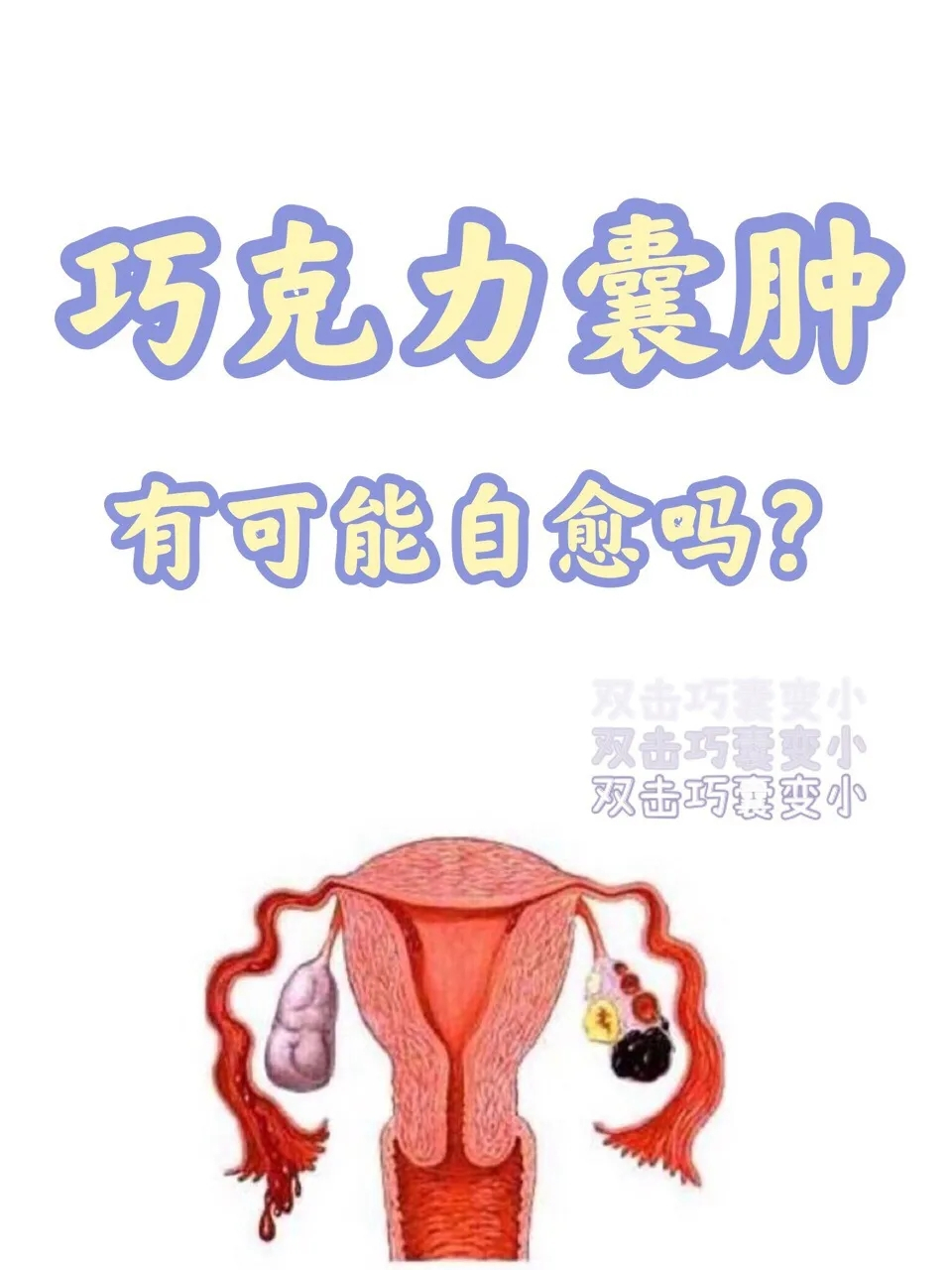 巧克力囊肿会自愈吗?