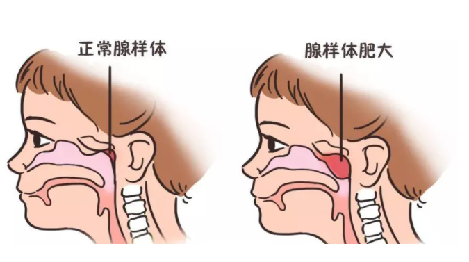 分享一個把兒童腺樣體肥大一鍋端的好消息!