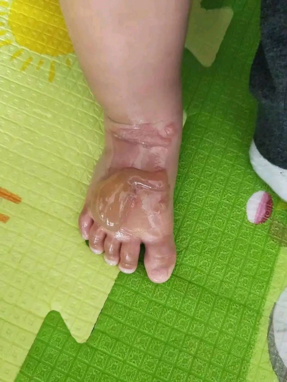 儿子被邻居热水瓶烫伤,妈妈因赔偿纠纷生恨,朝邻居孩子泼开水 ​