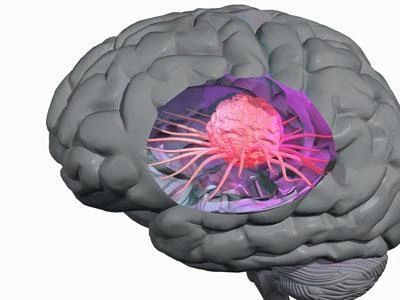 脑脓肿标本描述图片