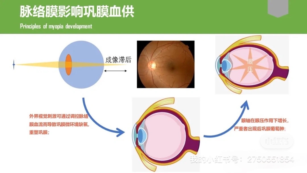 鞏膜—可能是縮短眼軸的關鍵