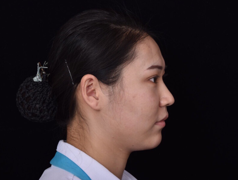 探讨垫下巴和使用玻尿酸两种丰下巴的方法,分析它们的优缺点