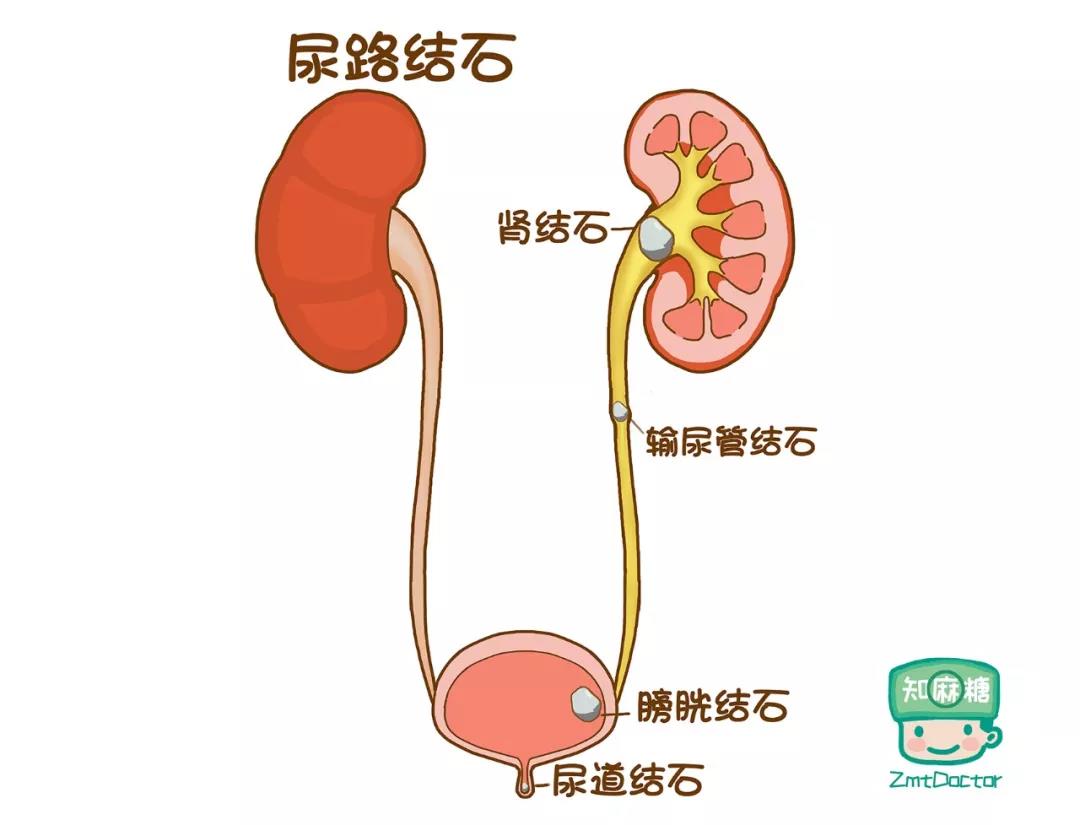 肾结石位置图片图片