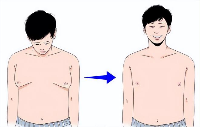 男性乳腺发育可以不用治疗吗