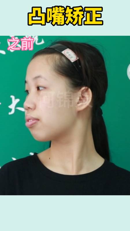 19岁凸嘴龅牙小妹妹,正颌后变更漂亮啦-度小视