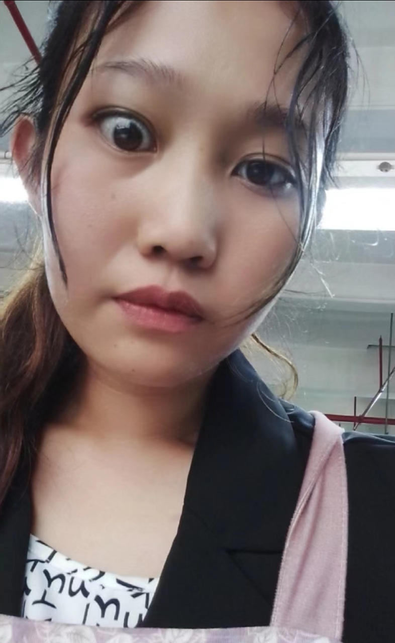 甲亢好了,突眼,粗脖子不见了!