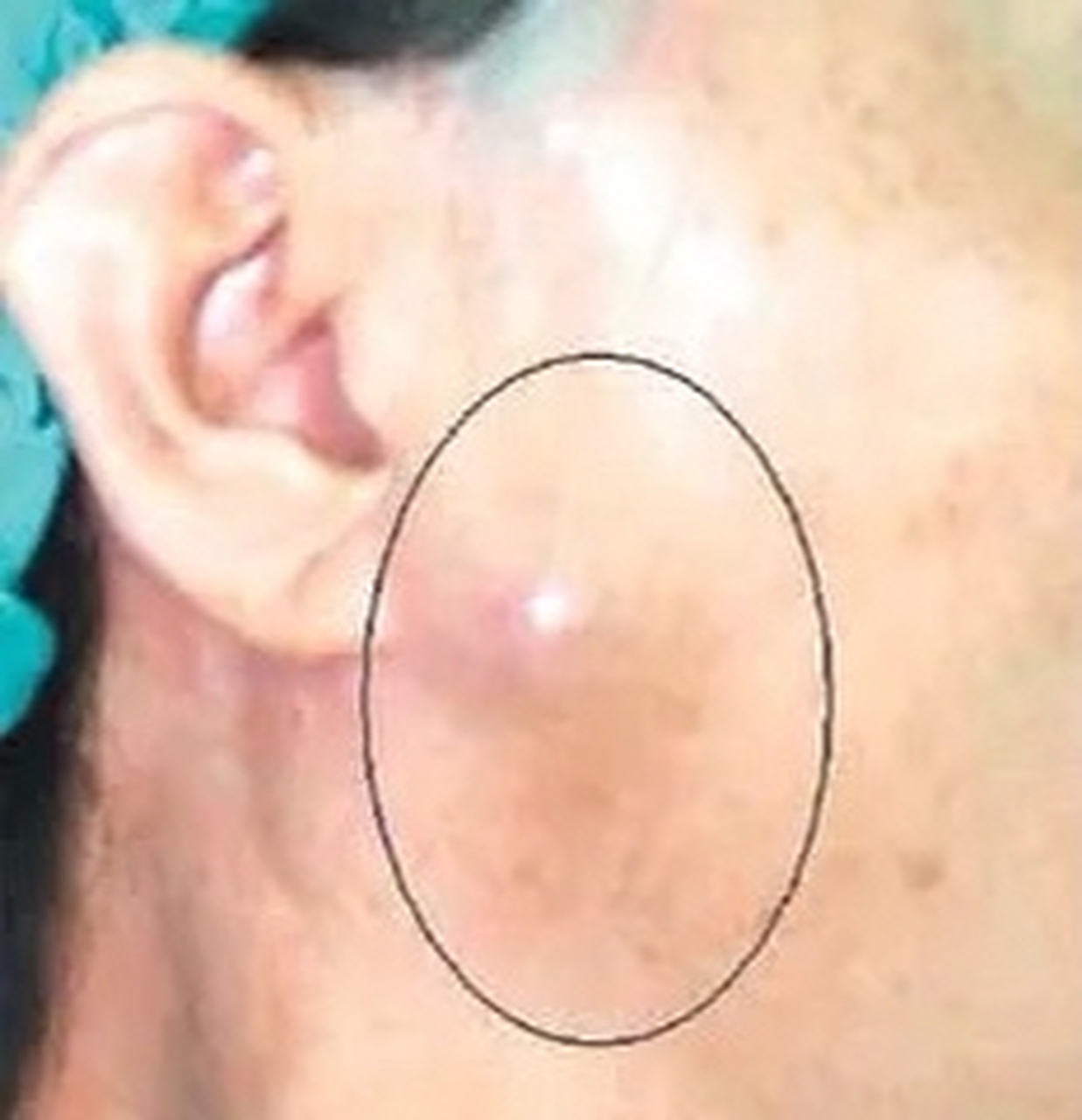 47岁的老杨,半年前右脸靠近耳垂的地方长了个肿块