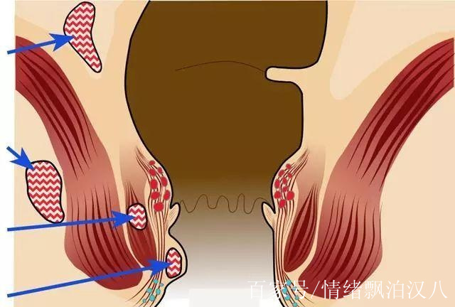 肛門疼痛,膿液要注意,他對痔瘡的危害更大,有可能得癌症