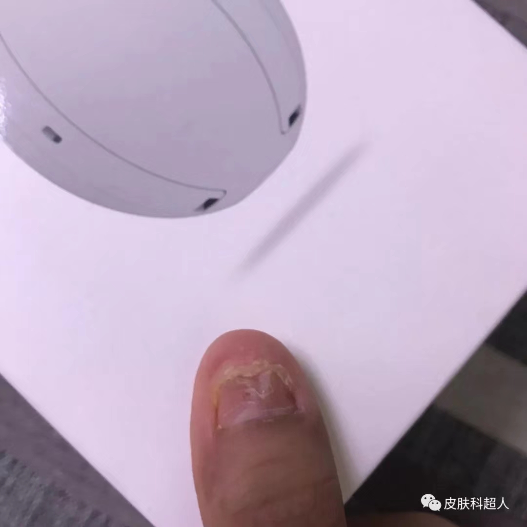 甲母痣的手术治疗分享