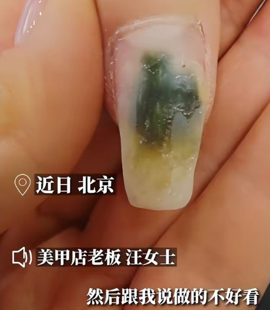 女子贴甲片后指甲发霉变绿,店老板:10个指头绿了6个,大拇指指甲和肉