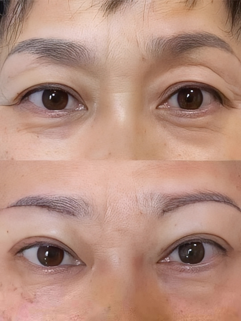 我上眼窝凹陷特别严重,凹进去像两个大窟窿一样,眼皮也很松垮,眼尾