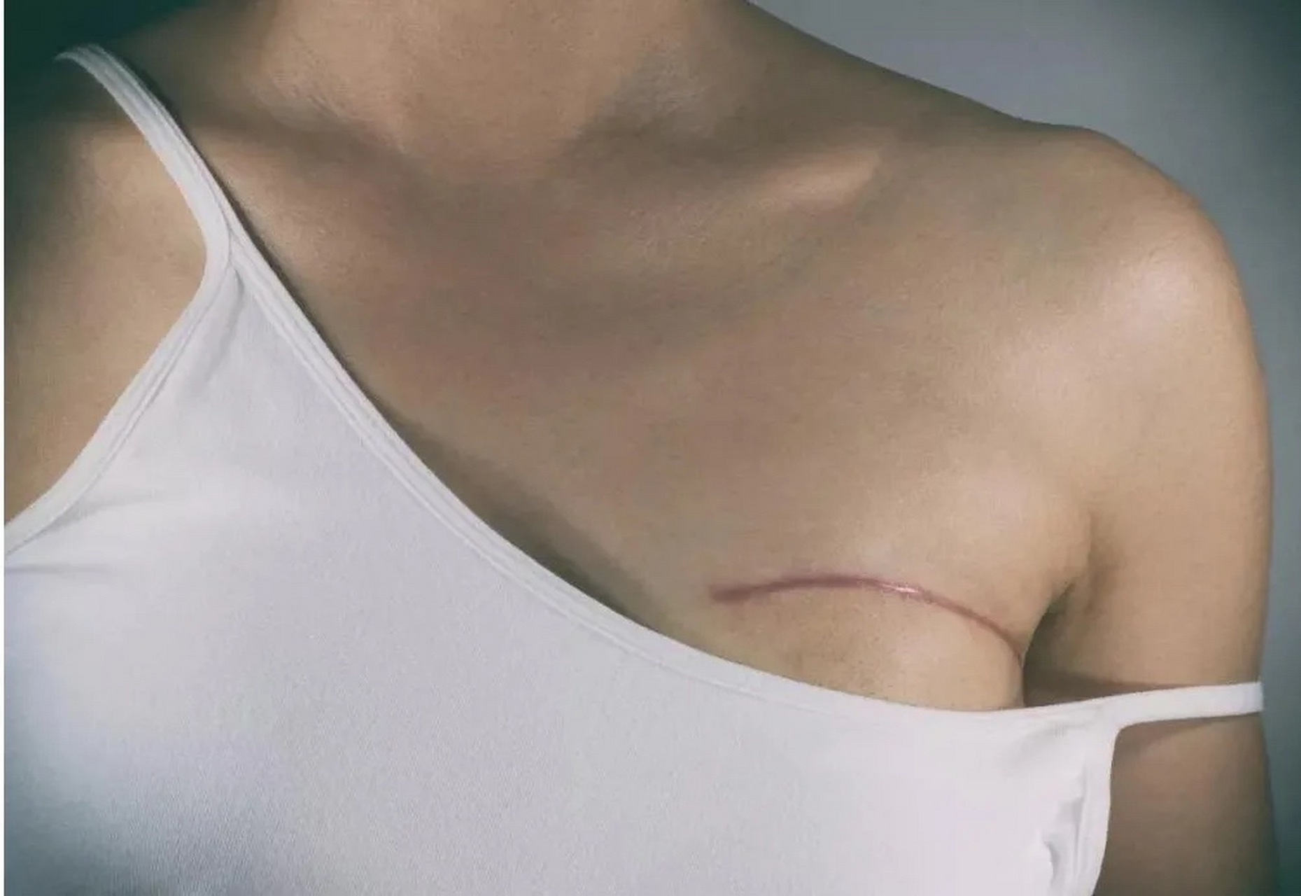 梁女士35岁,刚刚做完乳腺切除手术半个月,老公就提出了离婚.