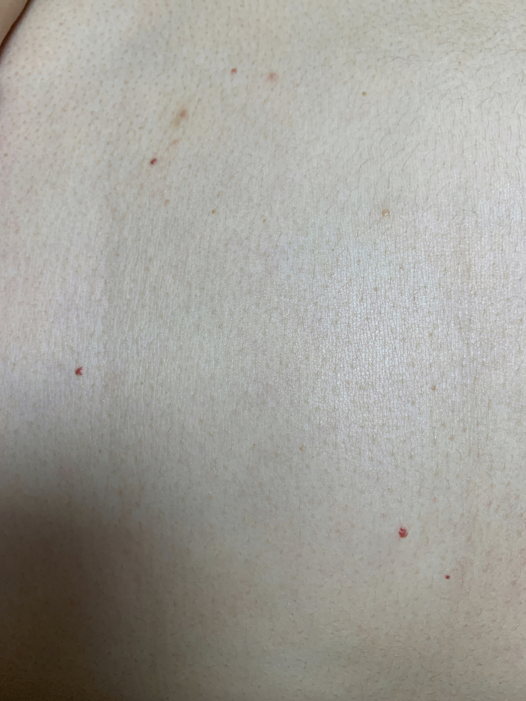 身上的血红小点疙瘩不痛不痒是什么?