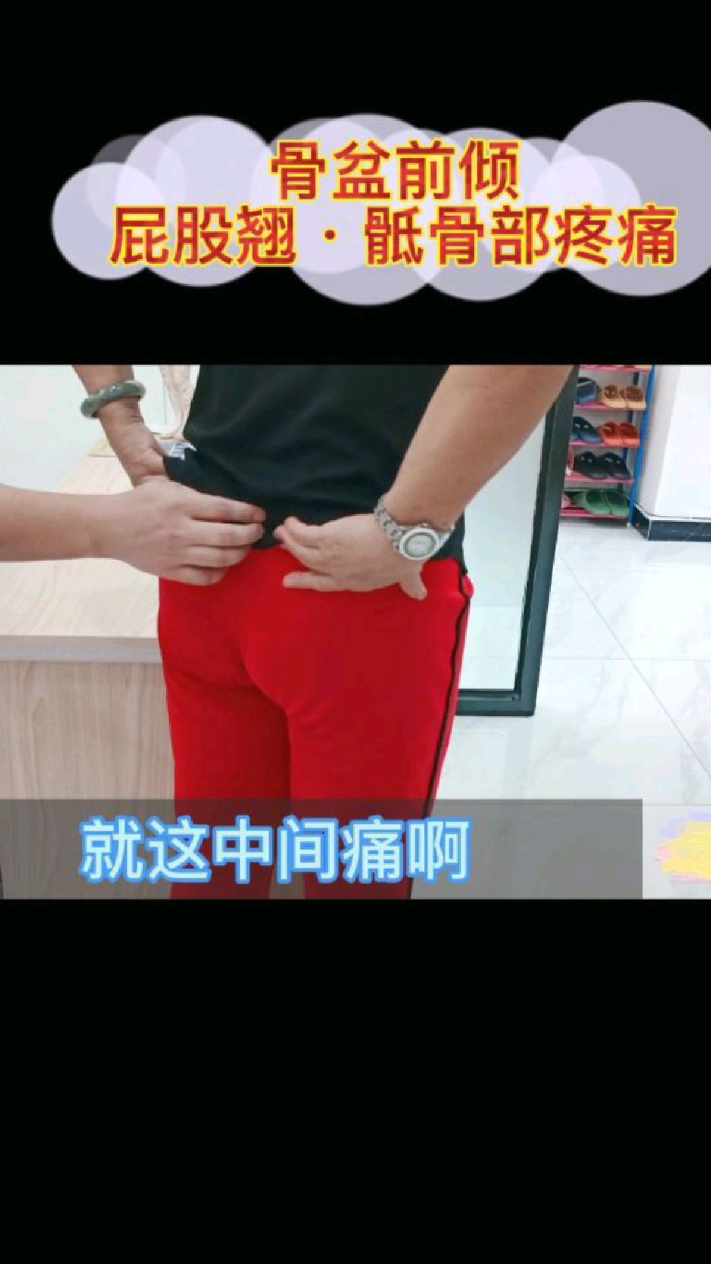 骶尾骨部疼痛骨盆前倾屁股翘