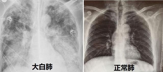 新冠肺炎片子图片