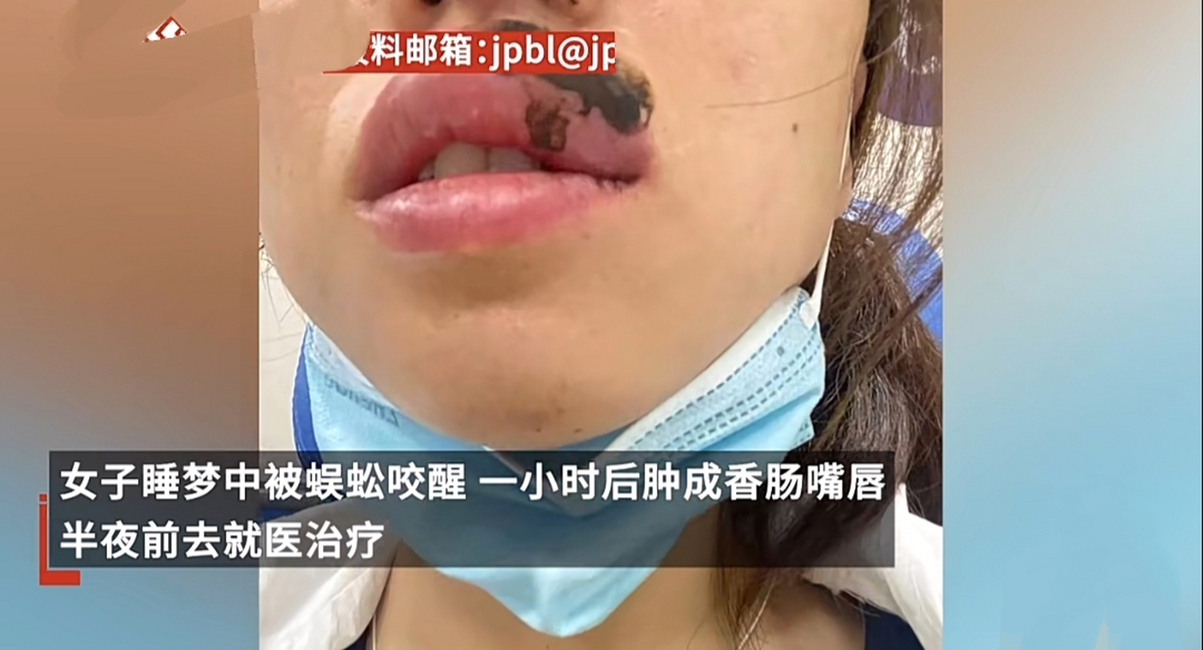 近日,江苏常州的一位女士在睡梦中被一只蜈蚣咬了一口,结果一小时后她