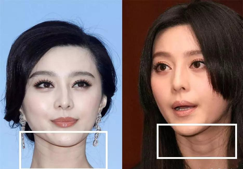 小小年纪有颈皱纹,这是过早衰老了吗?有颈纹应该怎么办呢?