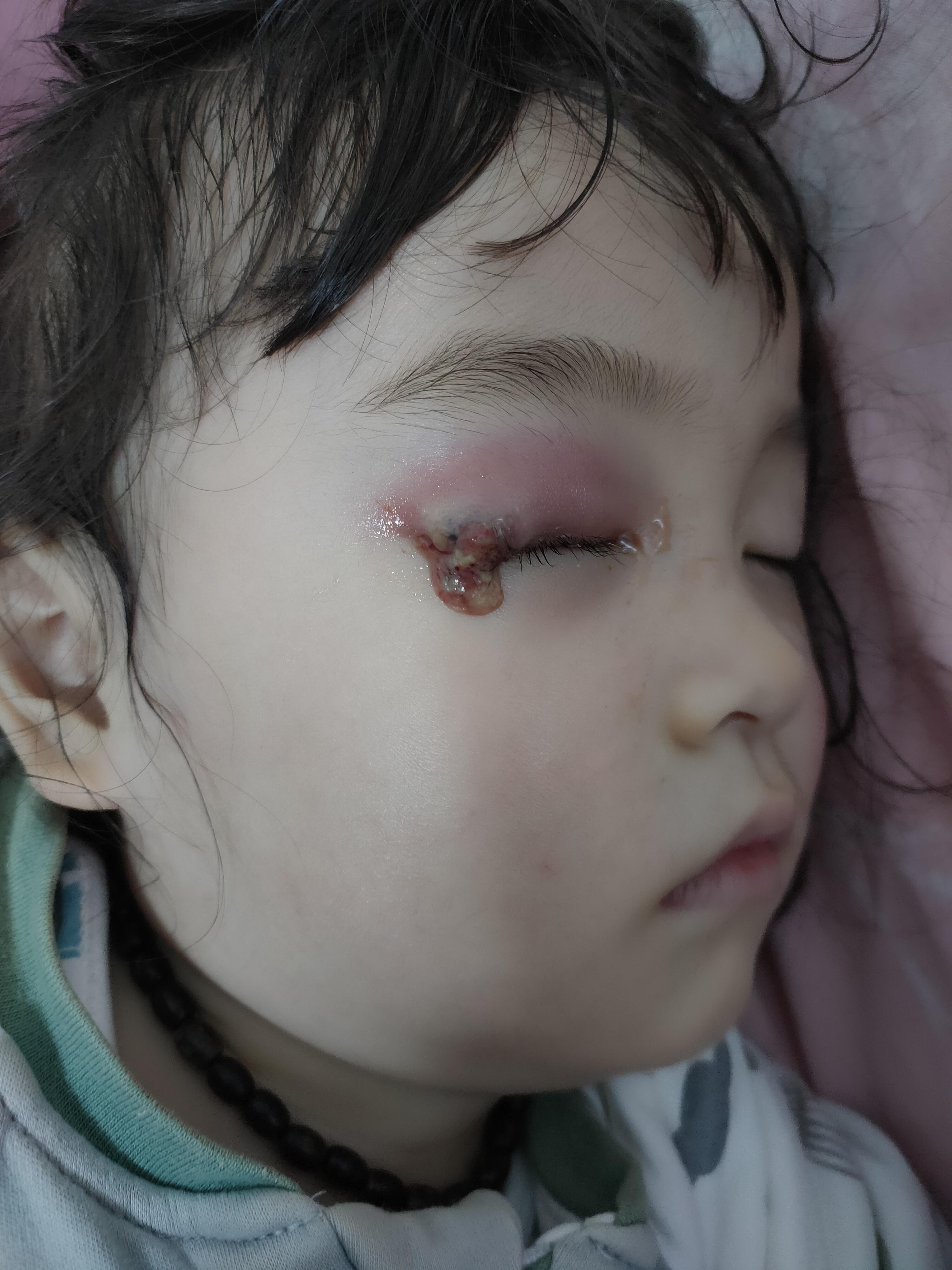 女儿眼皮上的麦粒肿,睡觉的时候终于破了,幸好是睡梦中