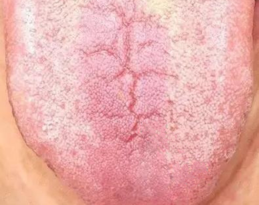 舌诊实战:怎么知道,自己是阴虚?看舌头一眼就知道!