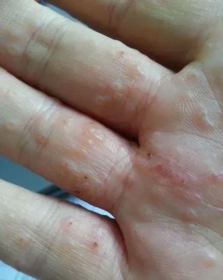 汗疱疹,你了解多少?