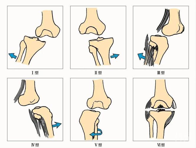 关节突交锁示意图图片