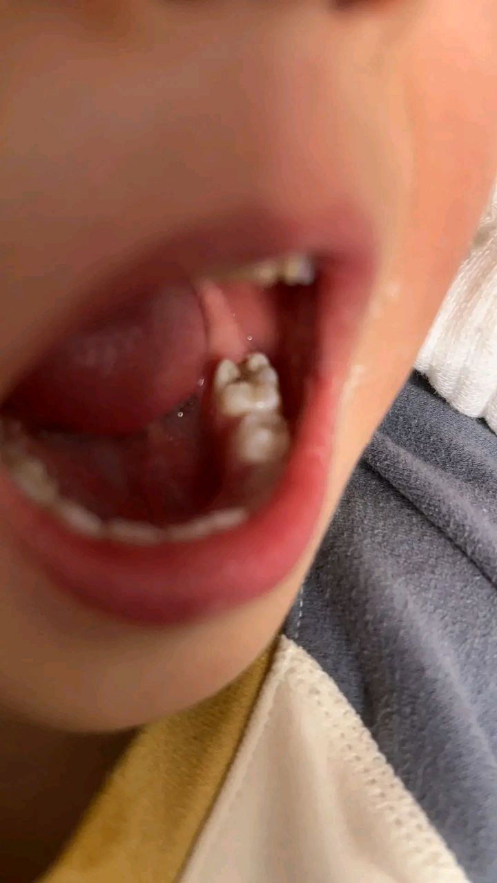 三岁的宝宝,牙齿坏了4颗.