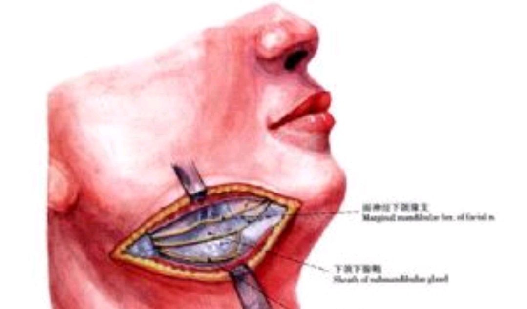 颌下淋巴结切除手术图片