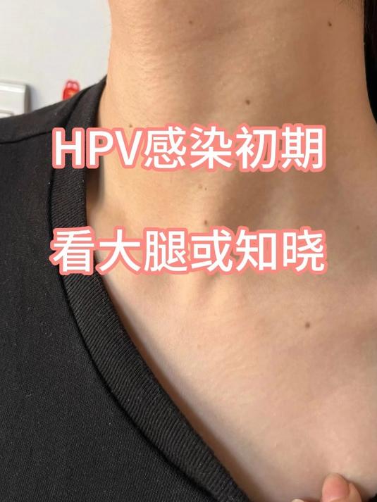 hpv感染初期,看大腿或知晓