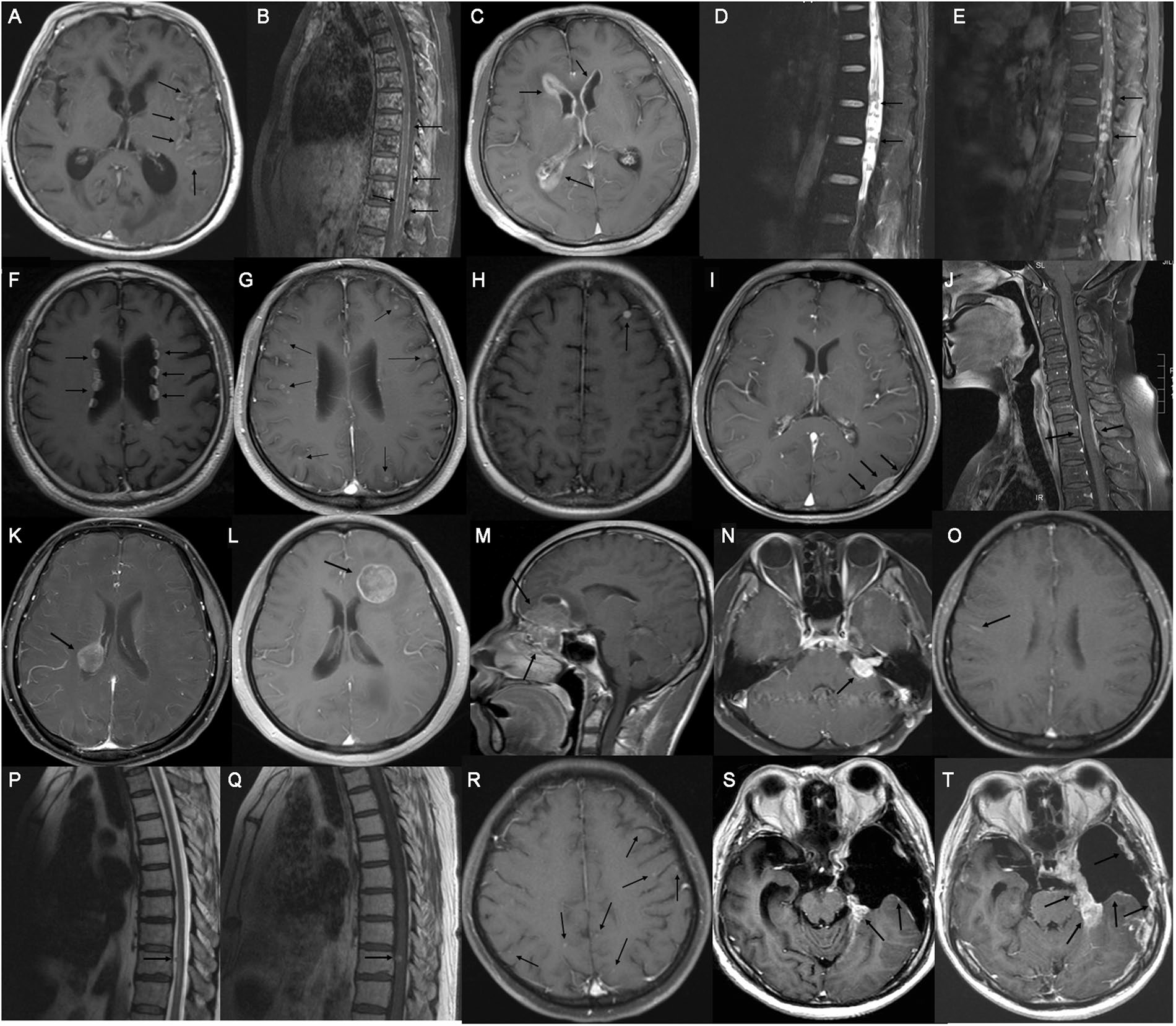 脑膜转移的主要临床特征和诊断方法