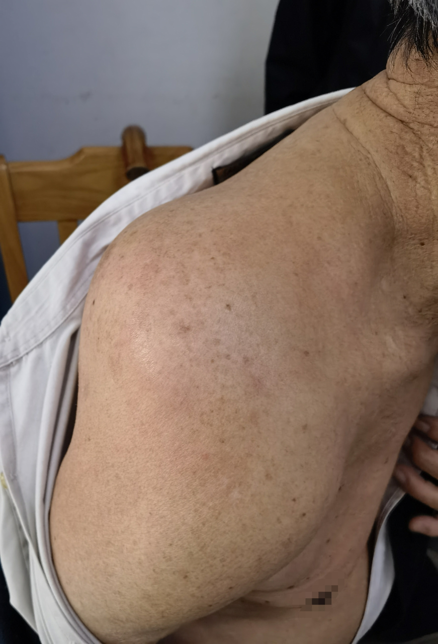 昨天门诊的一个老人家,近一两个月右侧肩部长了一个很大的包块肿物,不