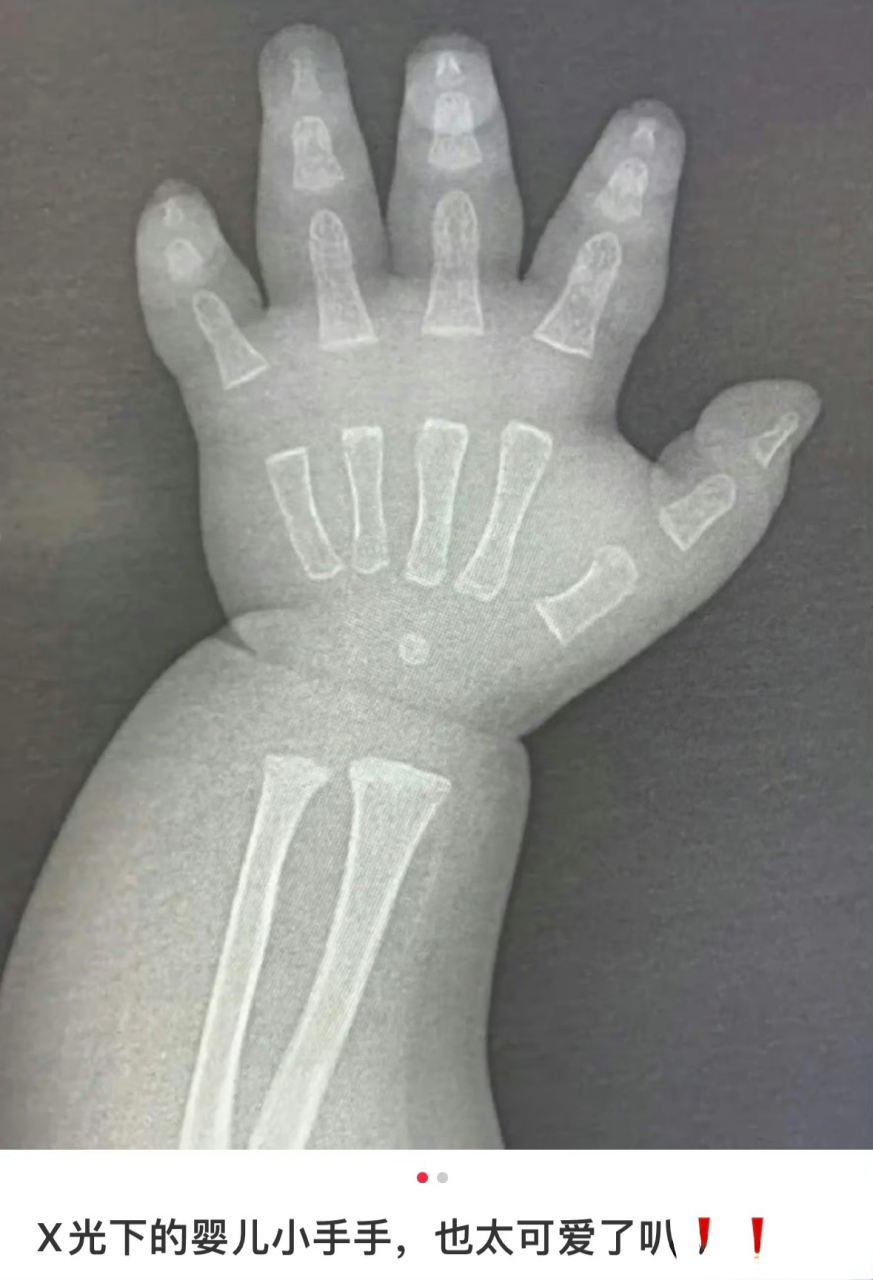 没想到x光下宝宝的小手是这样的,没想到骨骼这么小,也太可爱啦!