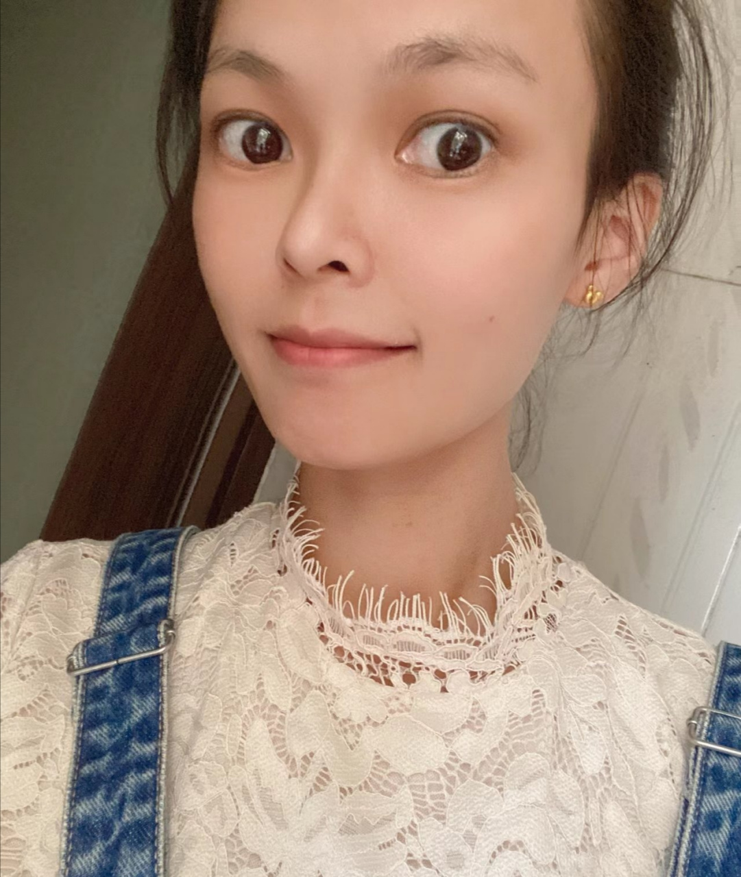 甲亢好了! 终于告别了多年的"突眼睛"