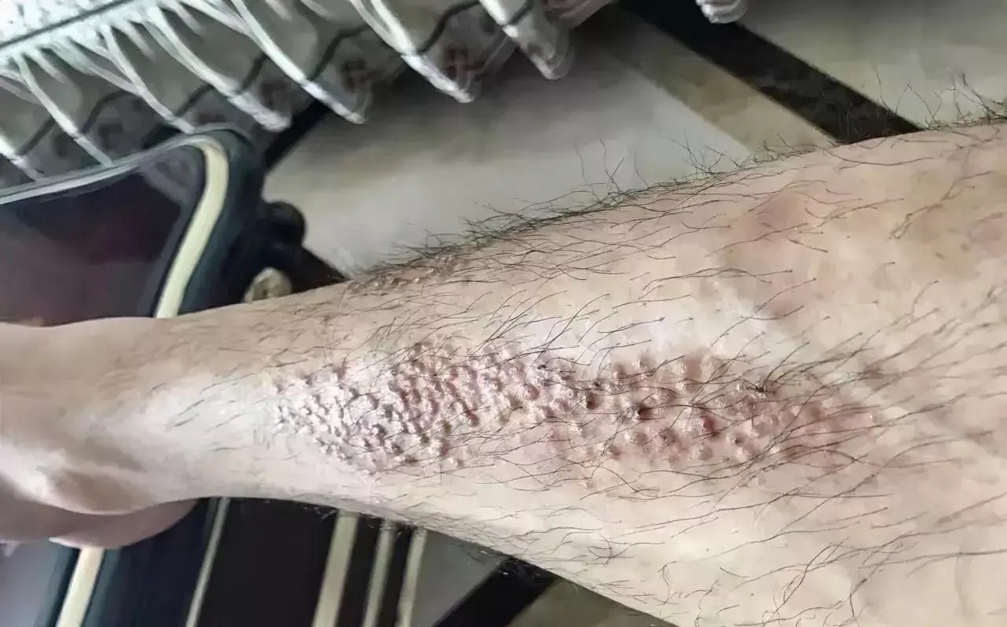 这是苔藓颗粒样淀粉样变,主要发在四肢的伸侧,以黄豆大小颗粒或者串珠