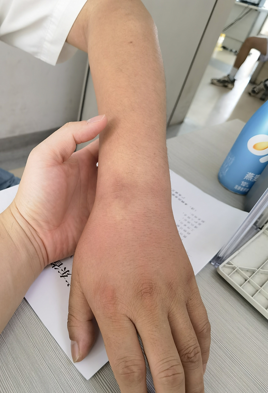 一觉睡醒,无缘无故地左手,手腕,前臂明显肿胀,腕关节屈伸严重受限.
