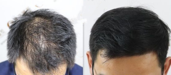 病理性脱发的判断与治疗方法