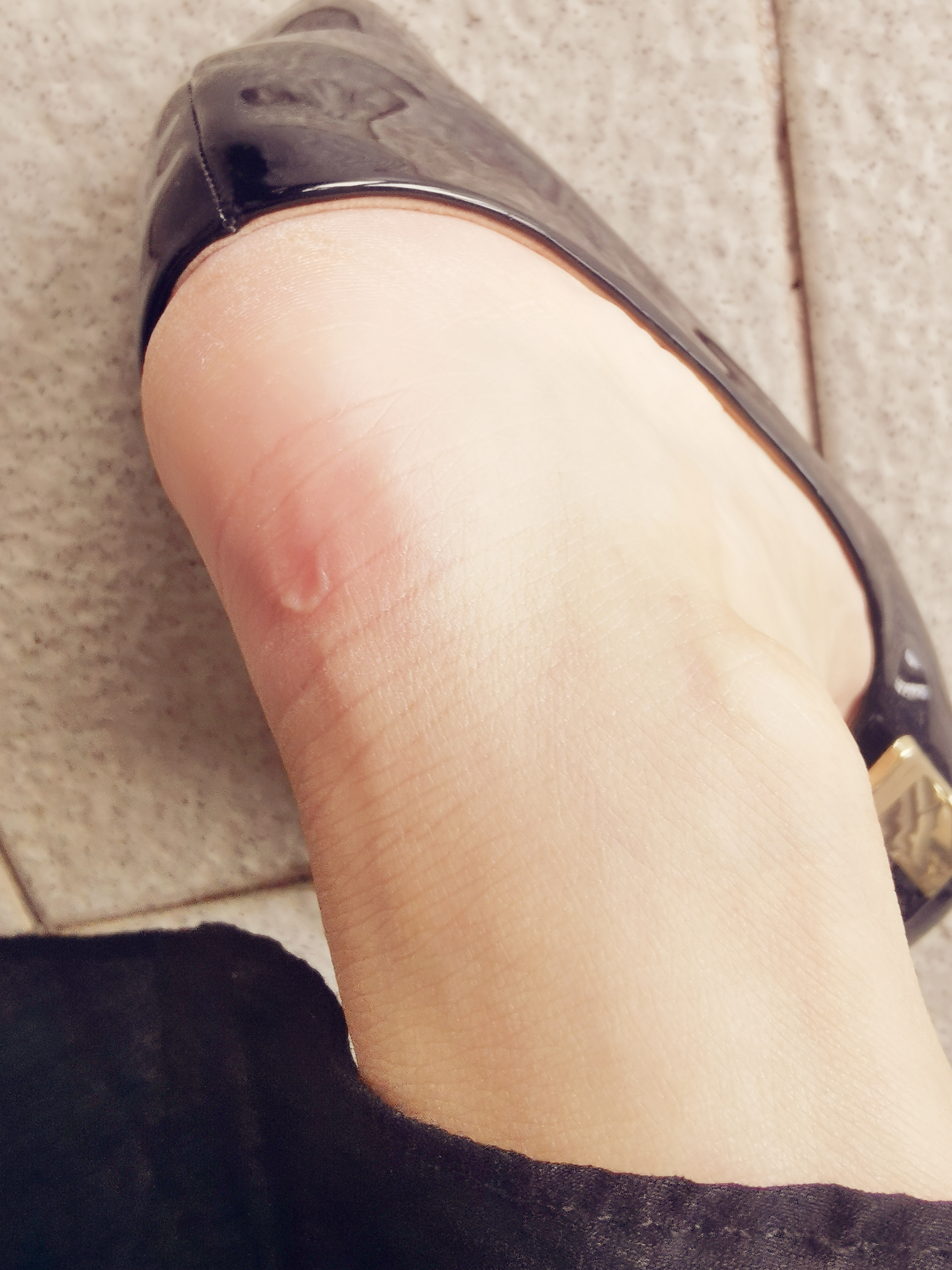 现在啥都别说了,先找脚后跟磨破皮图片脚后跟破皮的图片脚后跟破皮