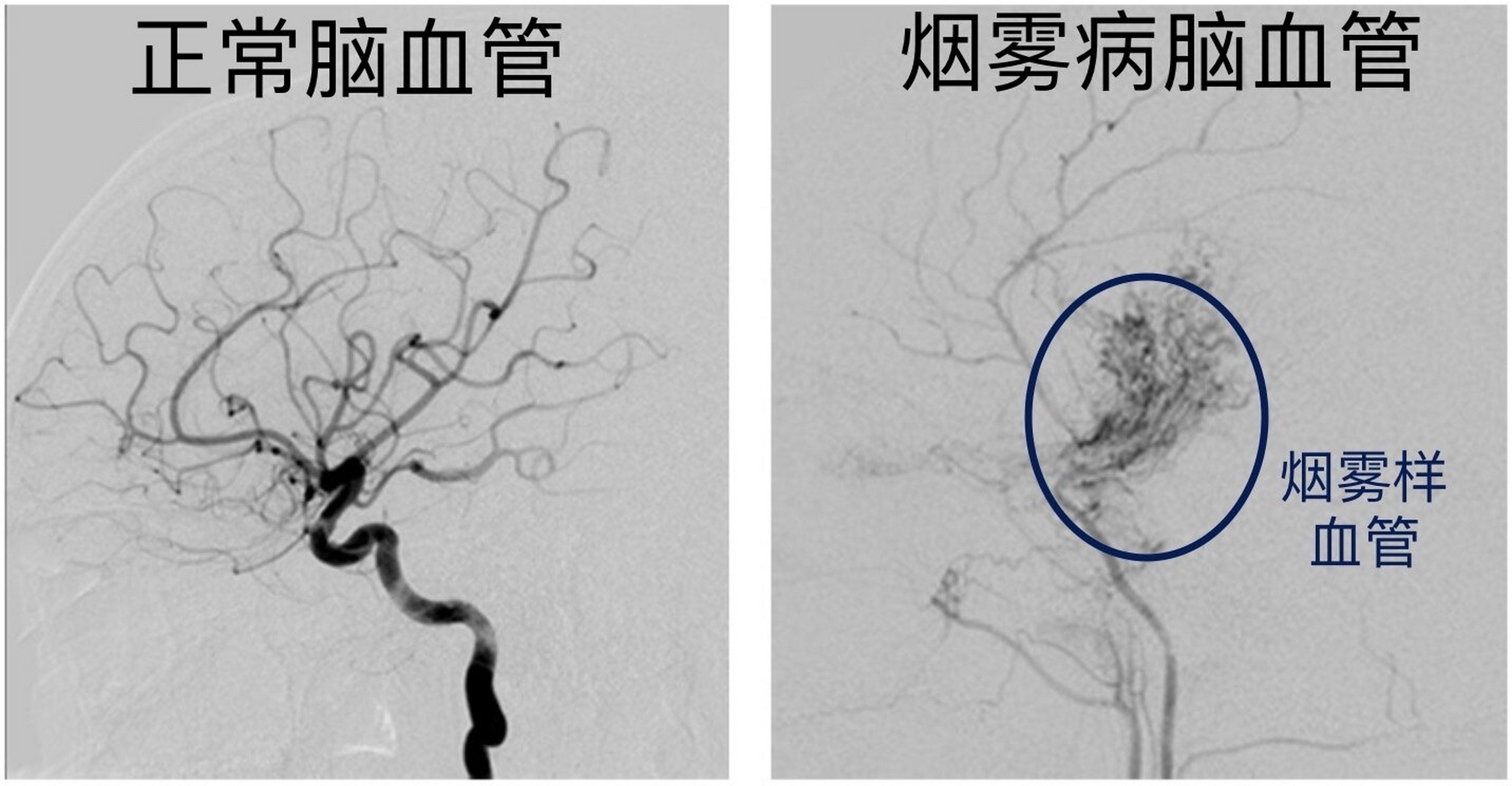 关于烟雾病的那些经历  烟雾病现在有一部分人已经人已经多少有些了解
