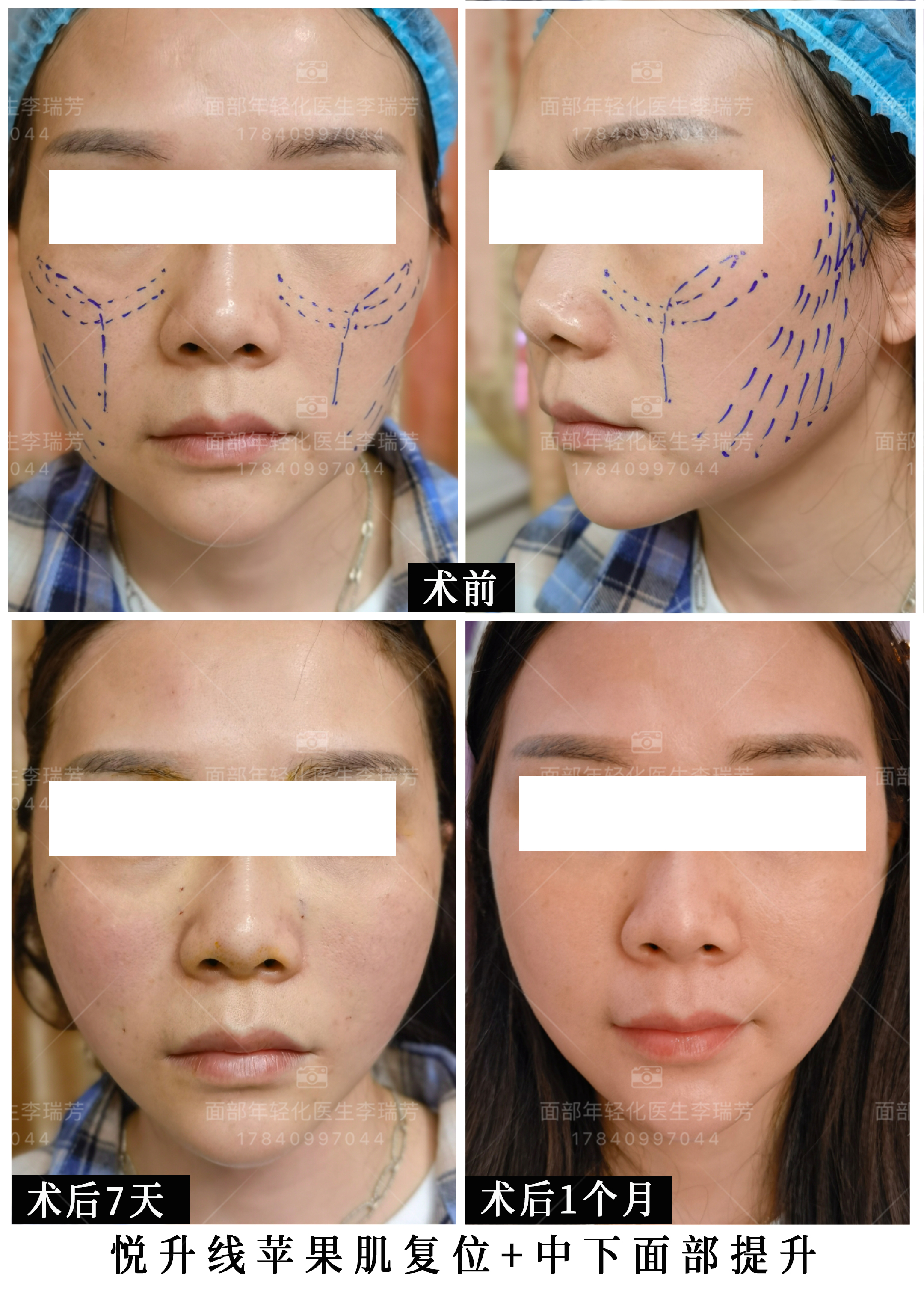 面部年轻化医生李瑞芳:悦升线效果
