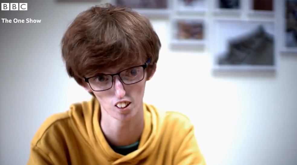 少年双颊消瘦"永远吃不胖"竟是罹患罕病,几率仅6亿分之1